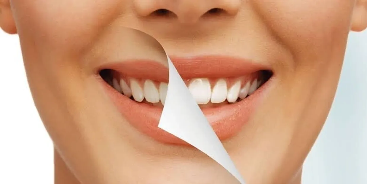 Can Laser Teeth Whitening Damage Your Dental Crowns Nuneaton?