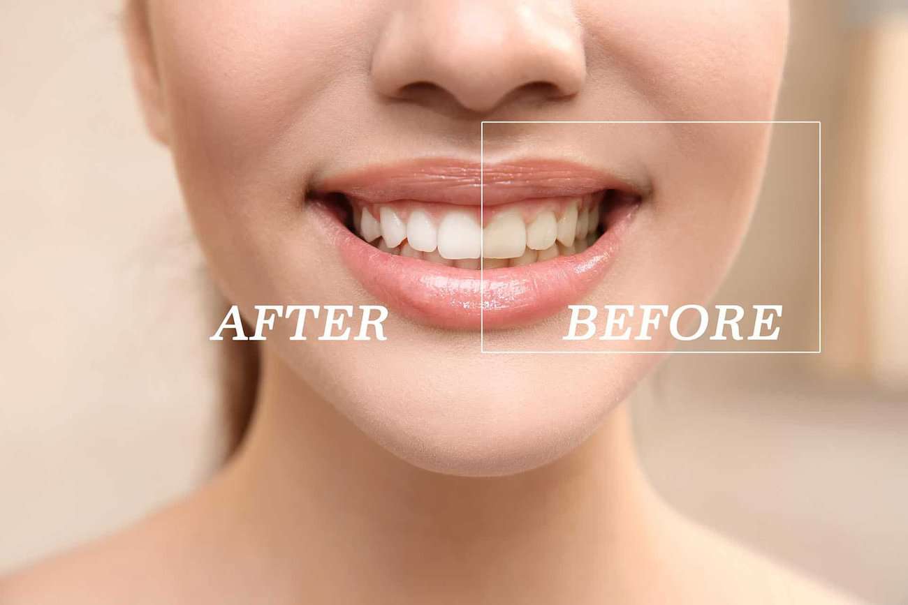 What Are the Most Effective Natural Teeth Whitening Methods You Can Try Nuneaton?