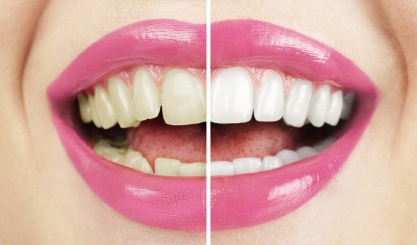 What Early Signs of Oral Cancer Should You Never Ignore Nuneaton?