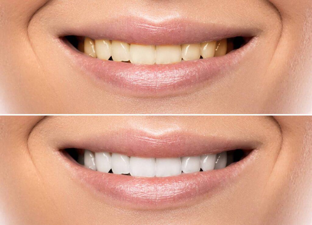 How Does Gum Disease Progress if Left Untreated Nuneaton?