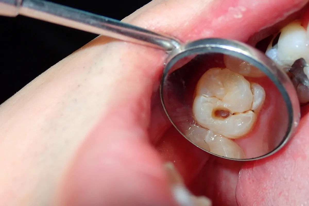 Why Do Teeth Crack? Common Causes to Know Nuneaton