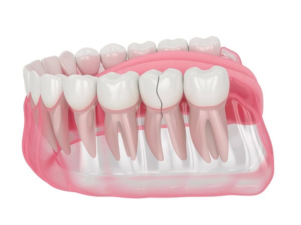 How Can You Manage Pain and Discomfort After a Root Canal Nuneaton?