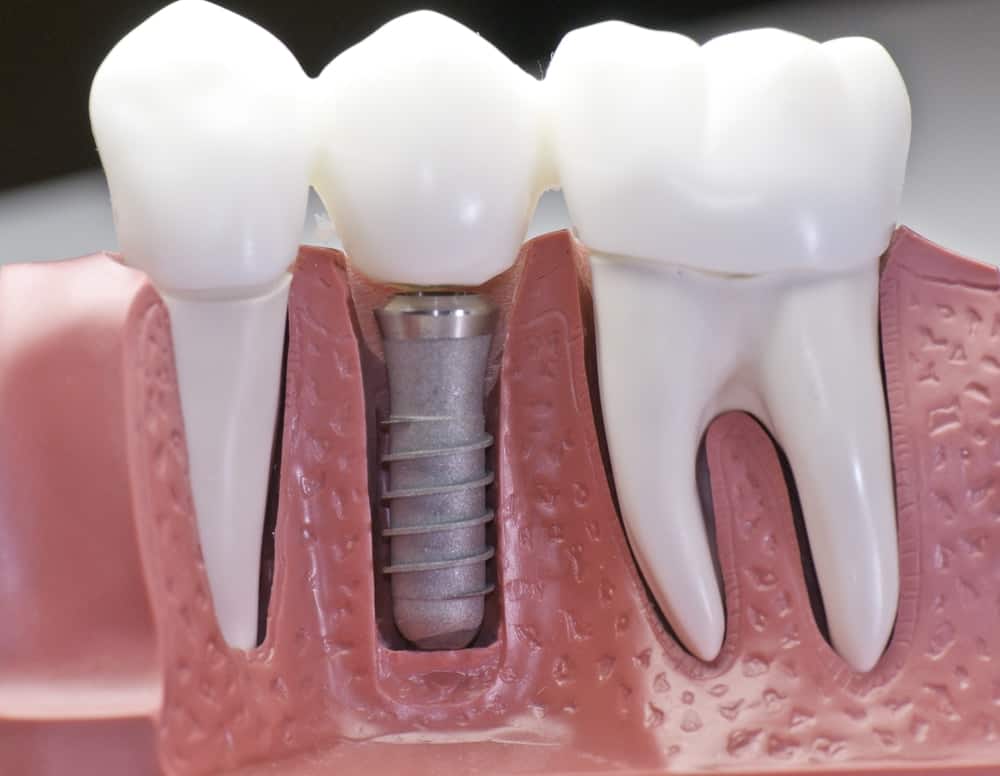 Common Misconceptions About Modern Dental Treatments Nuneaton
