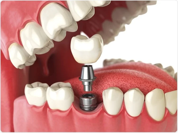 How Do I Decide Which Tooth Replacement Is Right for Me Nuneaton?
