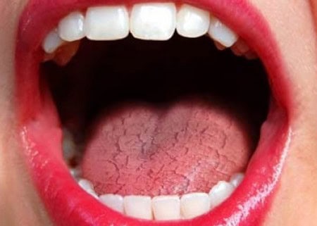 Common Causes of Dry Mouth (Xerostomia) Nuneaton