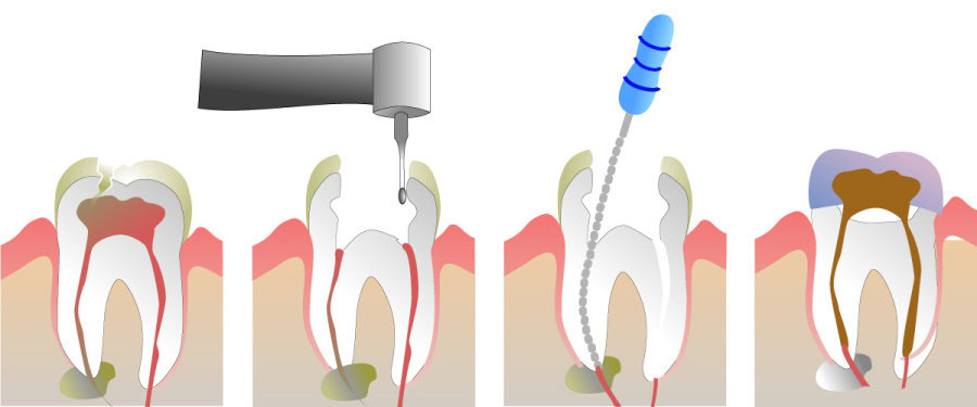 How Do You Properly Care for Your Teeth After a Root Canal Nuneaton