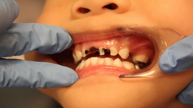 Which Foods and Drinks Cause the Most Damage to Young Smiles Nuneaton?