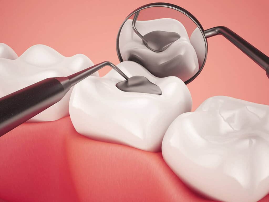 Fighting Cavities and Plaque Buildup Nuneaton
