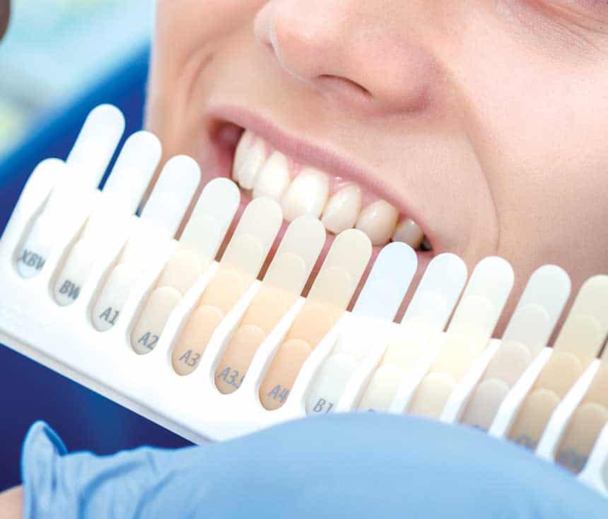 Professional vs At-Home Whitening: What You Need to Know Nuneaton