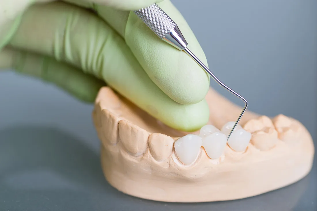 Do Braces Take Years to Show Results Nuneaton