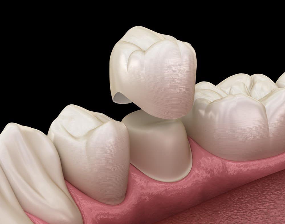 What Daily Habits Help Protect Your Dental Crowns Nuneaton?