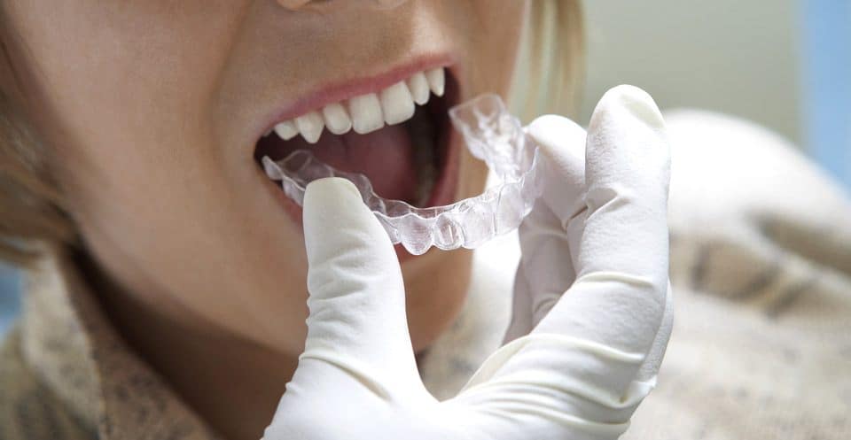Why Bleaching Trays Require More Time Nuneaton